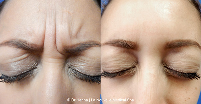 Botox, Xeomin before after photos Ventura County, La Nouvelle Medical Spa, Oxnard, Dr. Antoine Hanna, Dr. Jack Shenouda 