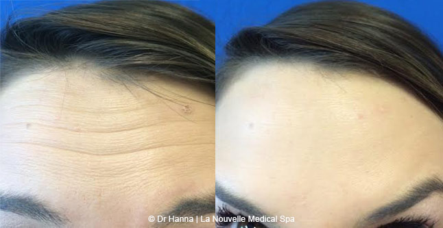 Botox, Xeomin before after photos Ventura County, La Nouvelle Medical Spa, Oxnard, Dr. Antoine Hanna, Dr. Jack Shenouda 