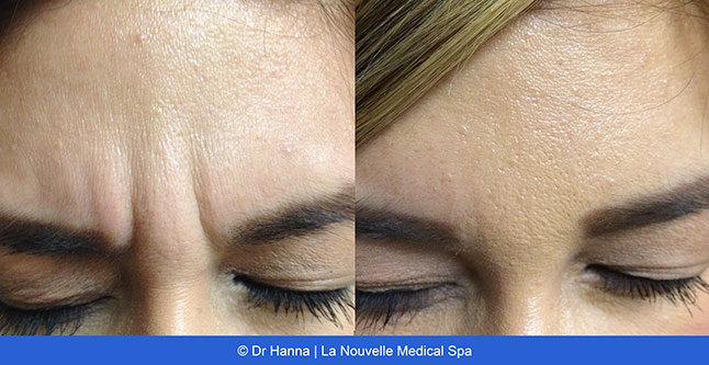 Botox, Xeomin before after photos Ventura County, La Nouvelle Medical Spa, Oxnard, Dr. Antoine Hanna, Dr. Jack Shenouda 
