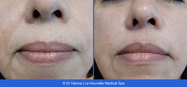Botox, Xeomin before after photos Ventura County, La Nouvelle Medical Spa, Oxnard, Dr. Antoine Hanna, Dr. Jack Shenouda 