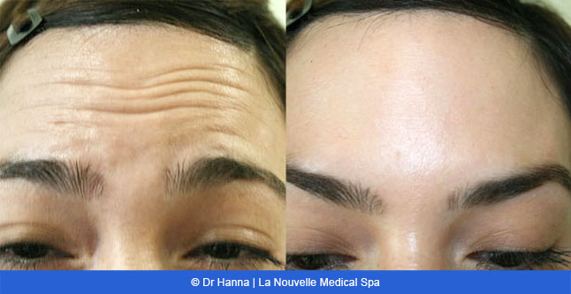 Botox, Xeomin before after photos Ventura County, La Nouvelle Medical Spa, Oxnard, Dr. Antoine Hanna, Dr. Jack Shenouda 