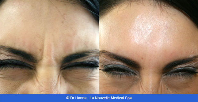 Botox, Xeomin before after photos Ventura County, La Nouvelle Medical Spa, Oxnard, Dr. Antoine Hanna, Dr. Jack Shenouda 