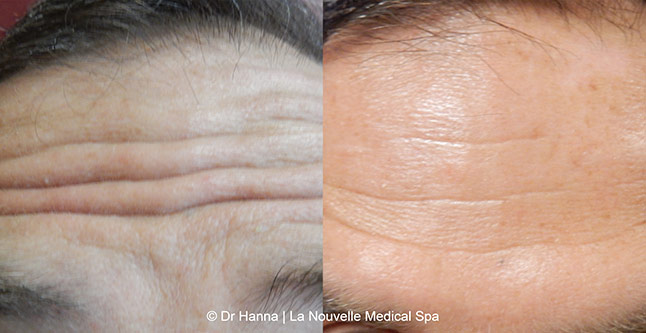 Botox, Xeomin before after photos Ventura County, La Nouvelle Medical Spa, Oxnard, Dr. Antoine Hanna, Dr. Jack Shenouda 