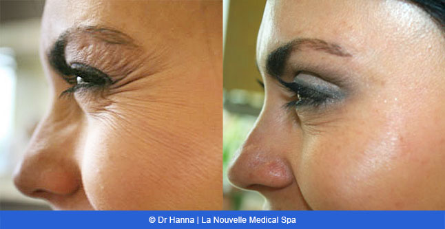 Botox, Xeomin before after photos Ventura County, La Nouvelle Medical Spa, Oxnard, Dr. Antoine Hanna, Dr. Jack Shenouda 