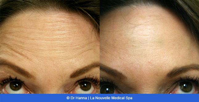 Botox, Xeomin before after photos Ventura County, La Nouvelle Medical Spa, Oxnard, Dr. Antoine Hanna, Dr. Jack Shenouda 