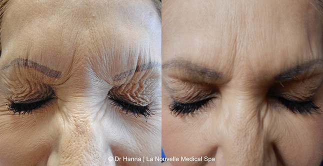 Botox, Xeomin before after photos Ventura County, La Nouvelle Medical Spa, Oxnard, Dr. Antoine Hanna, Dr. Jack Shenouda 