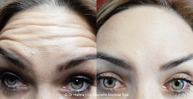 Botox, Xeomin before after photos Ventura County, La Nouvelle Medical Spa, Oxnard, Dr. Antoine Hanna, Dr. Jack Shenouda 