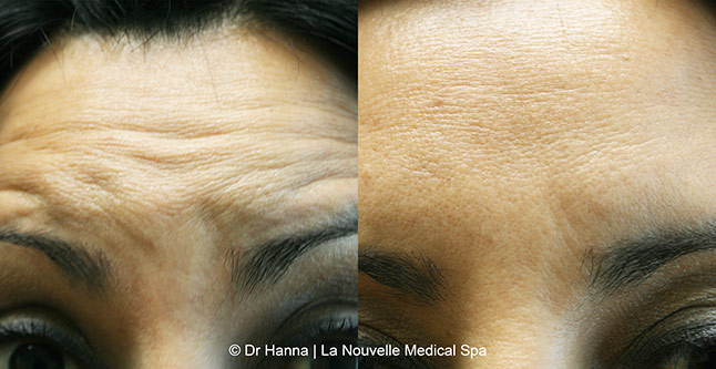 Botox, Xeomin before after photos Ventura County, La Nouvelle Medical Spa, Oxnard, Dr. Antoine Hanna, Dr. Jack Shenouda 