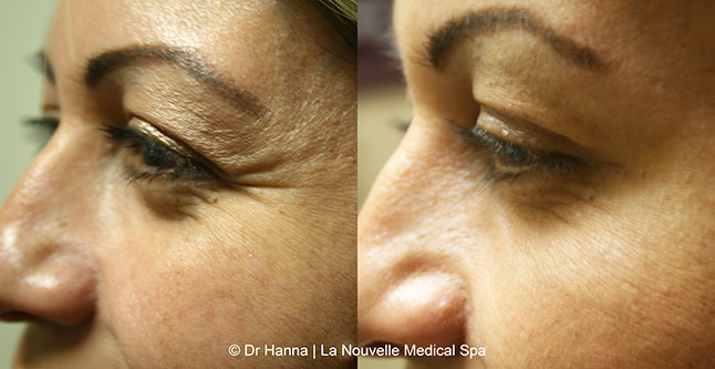Botox, Xeomin before after photos Ventura County, La Nouvelle Medical Spa, Oxnard, Dr. Antoine Hanna, Dr. Jack Shenouda 