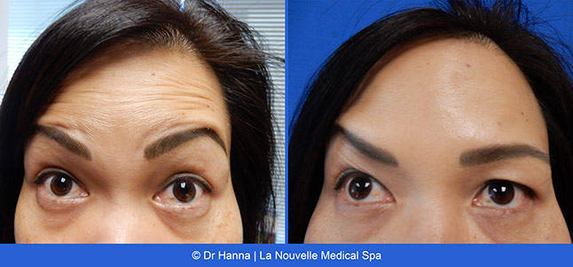 Botox, Xeomin before after photos Ventura County, La Nouvelle Medical Spa, Oxnard, Dr. Antoine Hanna, Dr. Jack Shenouda 