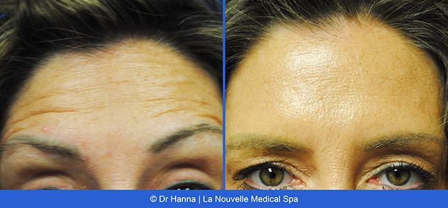 Botox, Xeomin before after photos Ventura County, La Nouvelle Medical Spa, Oxnard, Dr. Antoine Hanna, Dr. Jack Shenouda 