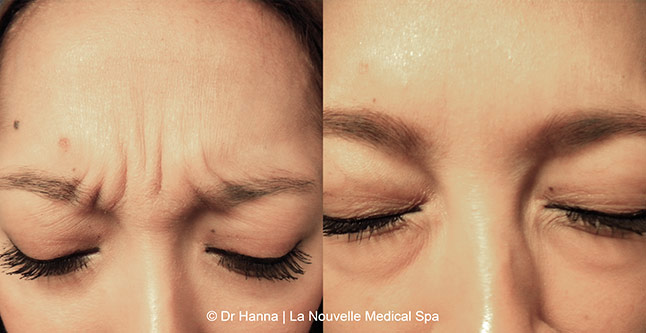 Botox, Xeomin before after photos Ventura County, La Nouvelle Medical Spa, Oxnard, Dr. Antoine Hanna, Dr. Jack Shenouda 