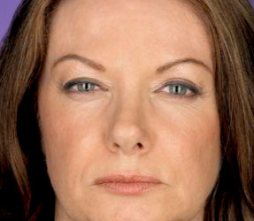 Botox injections for wrinkle removal - after photo, dr hanna, la nouvelle oxnard, ventura county