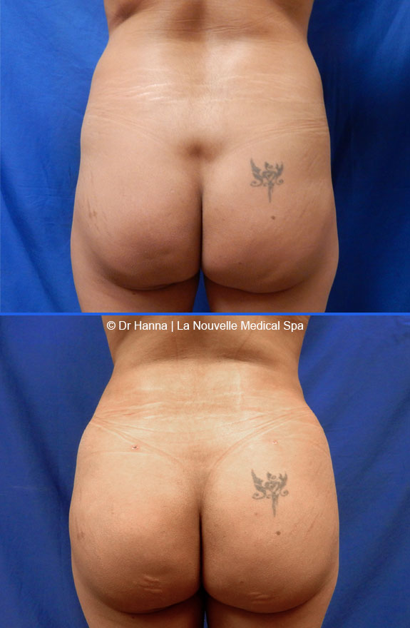brazilian butt lift by dr. hanna la nouvelle medical spa oxnard