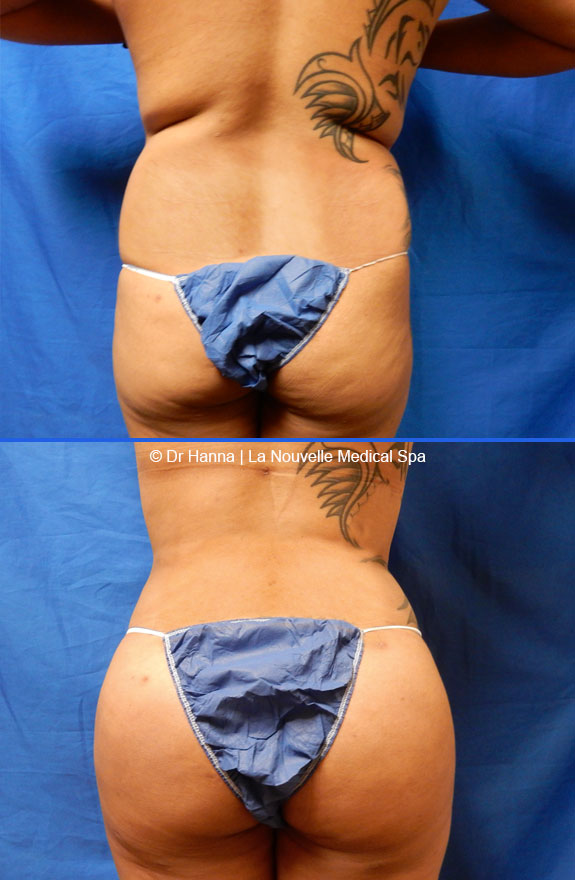 brazilian butt lift by dr. hanna la nouvelle medical spa oxnard