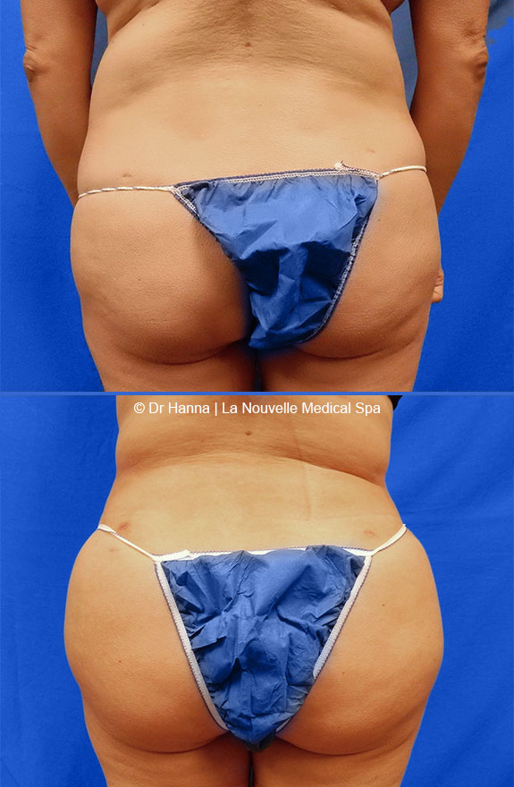 brazilian butt lift by dr. hanna la nouvelle medical spa oxnard