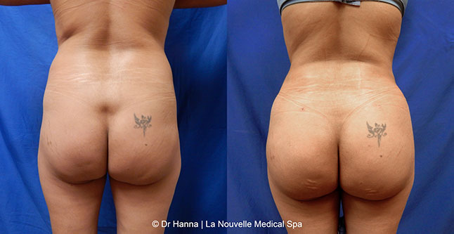Brazilian butt lift with liposuction before after Ventura County Dr. Hanna La Nouvelle Medical Spa, Oxnard
