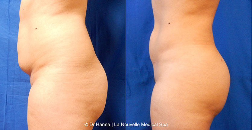 Brazilian butt lift with liposuction before after Ventura County Dr. Hanna La Nouvelle Medical Spa, Oxnard
