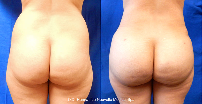 Brazilian butt lift with liposuction before after Ventura County Dr. Hanna La Nouvelle Medical Spa, Oxnard