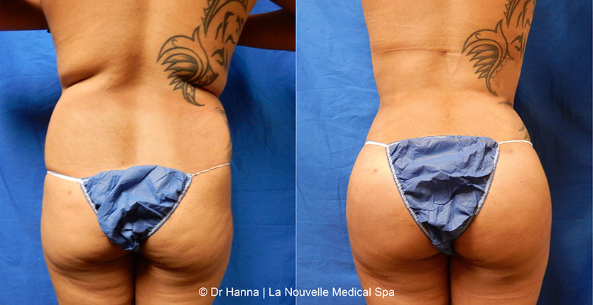 Brazilian butt lift with liposuction before after Ventura County Dr. Hanna La Nouvelle Medical Spa, Oxnard