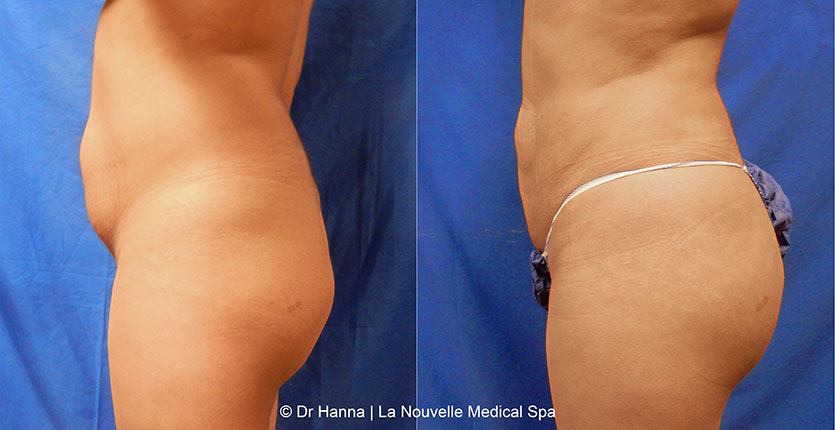 Brazilian butt lift with liposuction before after Ventura County Dr. Hanna La Nouvelle Medical Spa, Oxnard