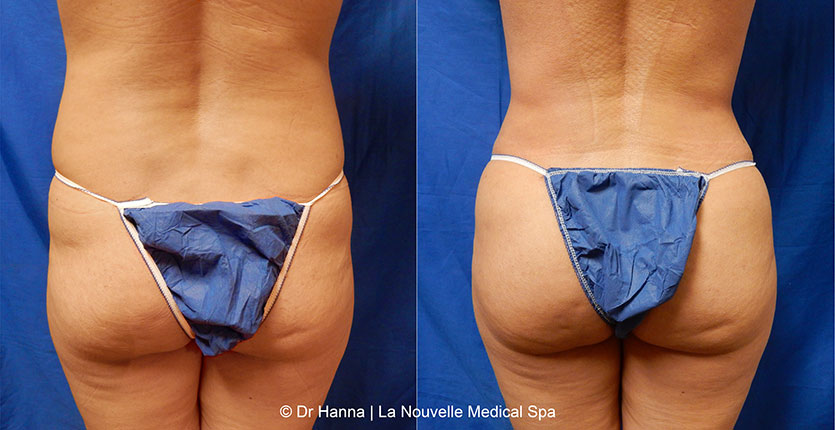 Brazilian butt lift with liposuction before after Ventura County Dr. Hanna La Nouvelle Medical Spa, Oxnard