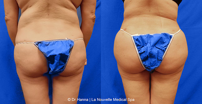 Brazilian butt lift with liposuction before after Ventura County Dr. Hanna La Nouvelle Medical Spa, Oxnard