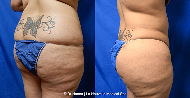 Brazilian butt lift with liposuction before after Ventura County Dr. Hanna La Nouvelle Medical Spa, Oxnard