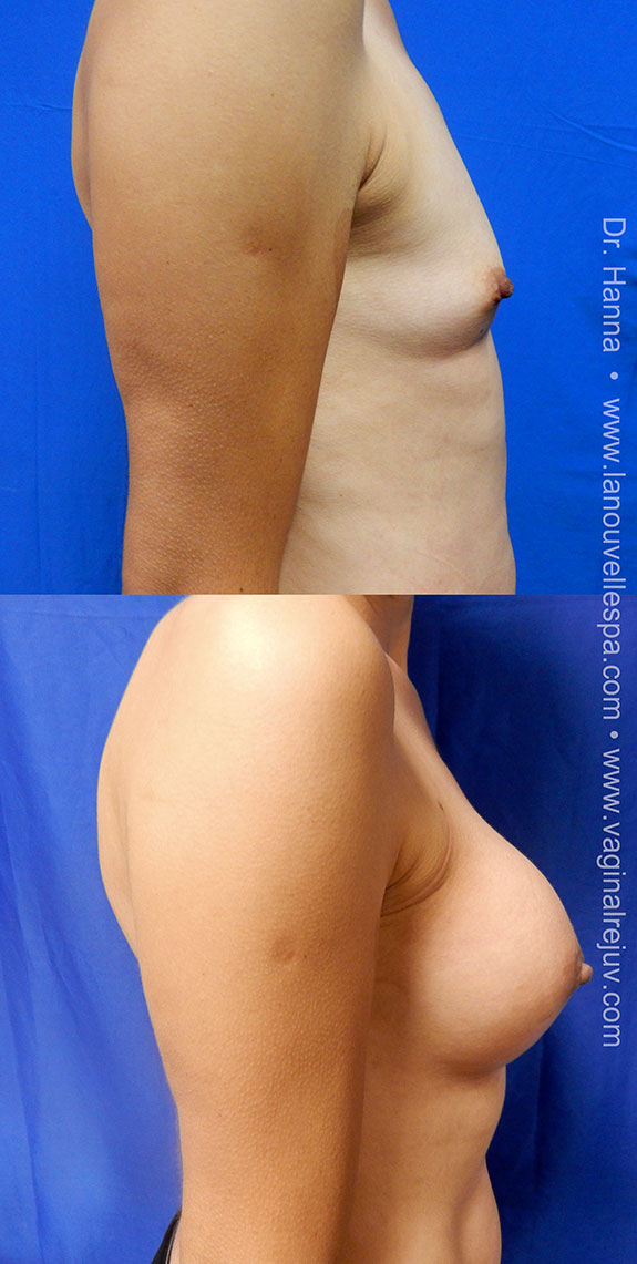 breast enhancement with silicone implants dr hanna la nouvelle oxnard Ventura County, los angeles