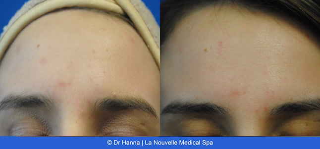 Chemical Peels VI Peel before after photos, La Nouvelle Medical Spa, Oxnard, Ventura County