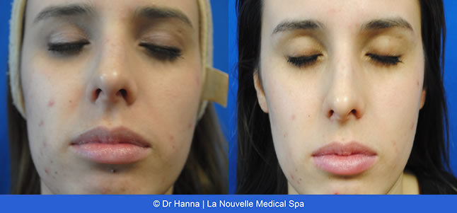 Chemical Peels VI Peel before after photos, La Nouvelle Medical Spa, Oxnard, Ventura County
