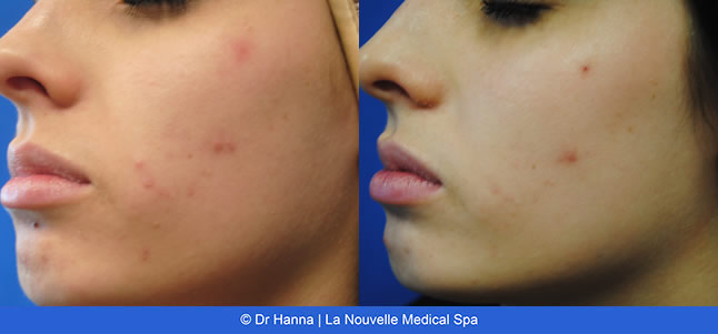 Chemical Peels VI Peel before after photos, La Nouvelle Medical Spa, Oxnard, Ventura County