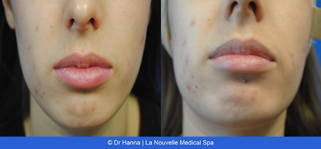 Chemical Peels VI Peel before after photos, La Nouvelle Medical Spa, Oxnard, Ventura County