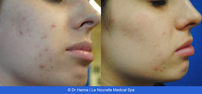 Chemical Peels VI Peel before after photos, La Nouvelle Medical Spa, Oxnard, Ventura County
