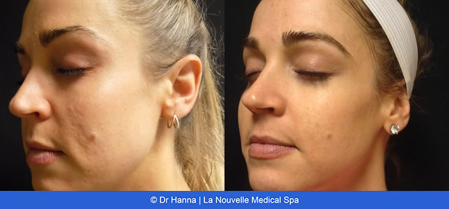Chemical Peels VI Peel before after photos, La Nouvelle Medical Spa, Oxnard, Ventura County