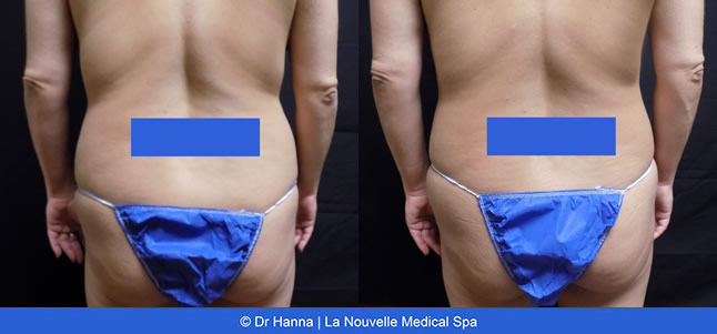CoolSculpting before and after photos Ventura County La Nouvelle Medical Spa, Oxnard