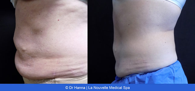 CoolSculpting before and after photos Ventura County La Nouvelle Medical Spa, Oxnard