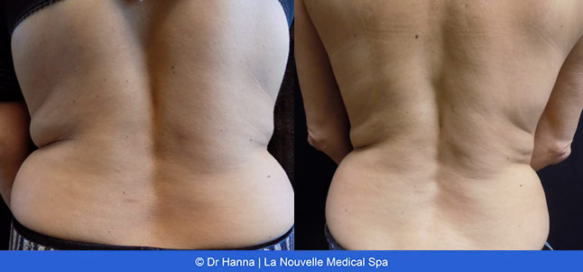 CoolSculpting before and after photos Ventura County La Nouvelle Medical Spa, Oxnard
