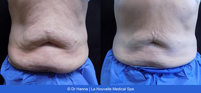 CoolSculpting before and after photos Ventura County La Nouvelle Medical Spa, Oxnard
