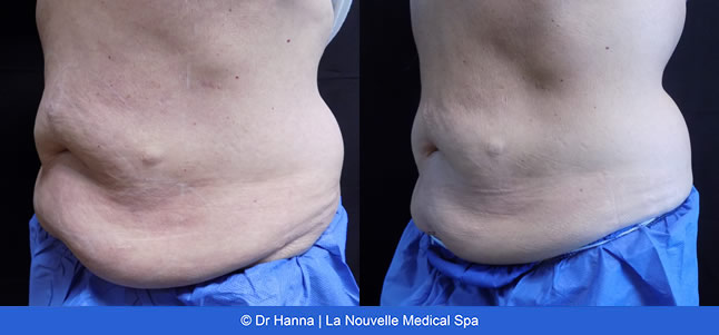 CoolSculpting before and after photos Ventura County La Nouvelle Medical Spa, Oxnard