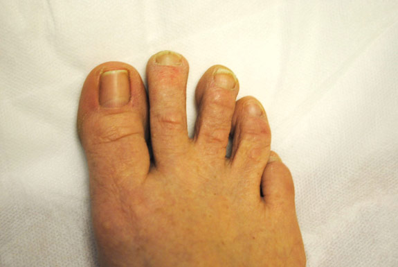 fungus toe nail treatments by laser genesis after photo