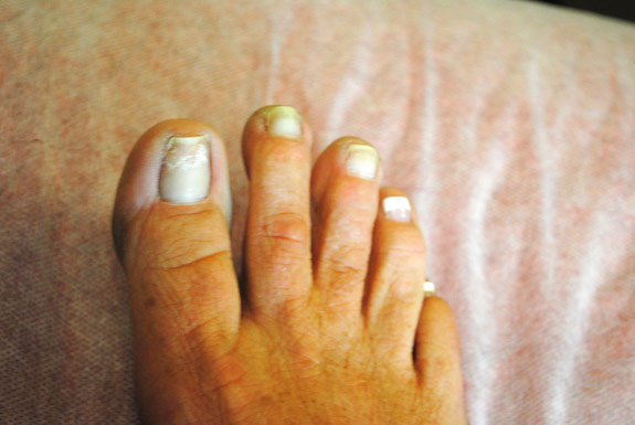 fungus toe nail treatments by laser genesis before photo
