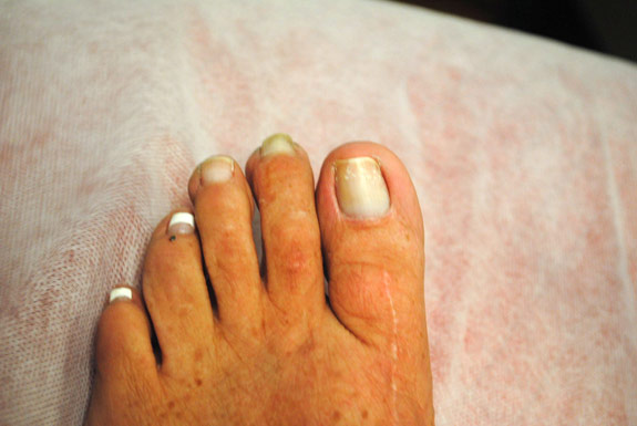 fungus toe nail treatments by laser genesis before photo