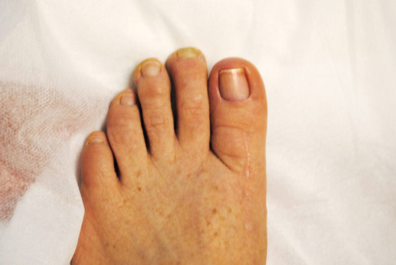 fungus toe nail treatments by laser genesis after photo