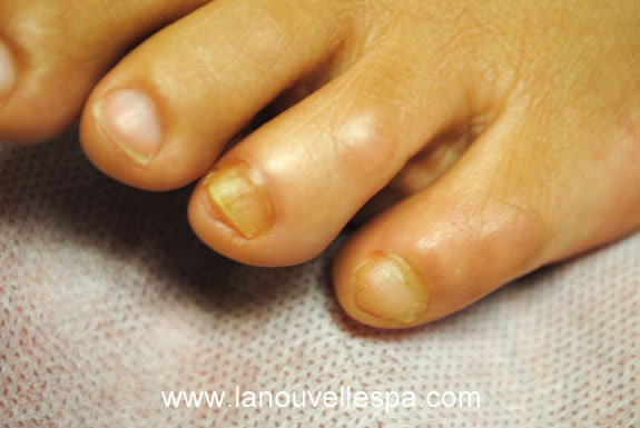 fungus toe nail treatments by laser genesis after photo