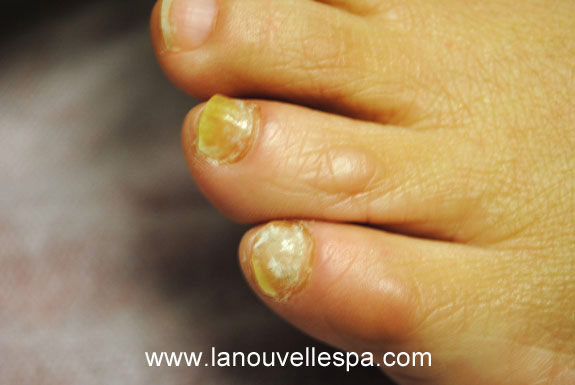 fungus toe nail treatments by laser genesis before photo