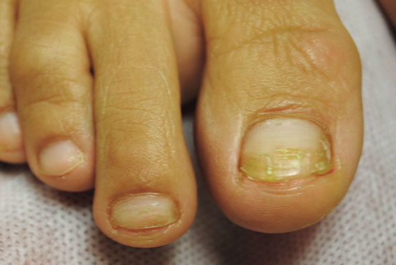 fungus toe nail treatments by laser genesis after photo