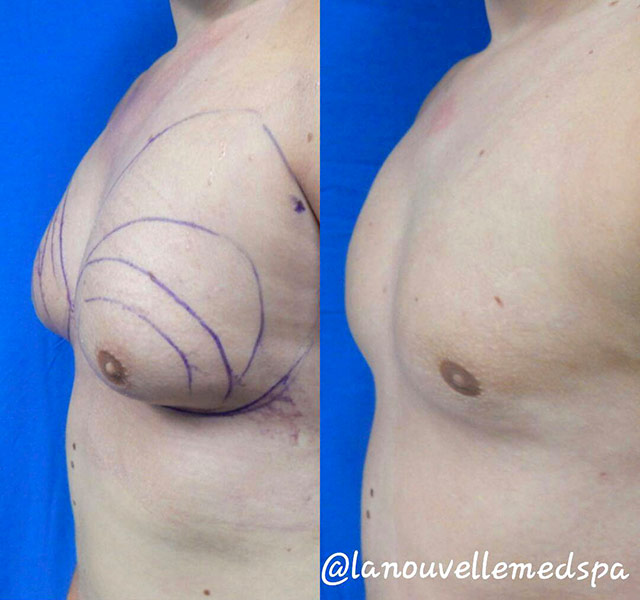 ginecomastia de reducción mamaria masculina antes después la nouvelle medical spa dr hanna ventura county