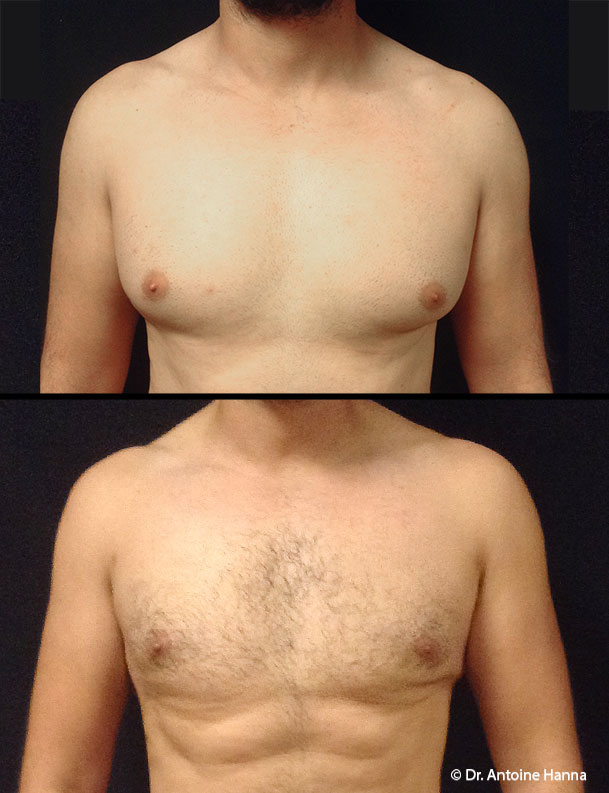 ginecomastia de reducción mamaria masculina antes después la nouvelle medical spa dr hanna ventura county