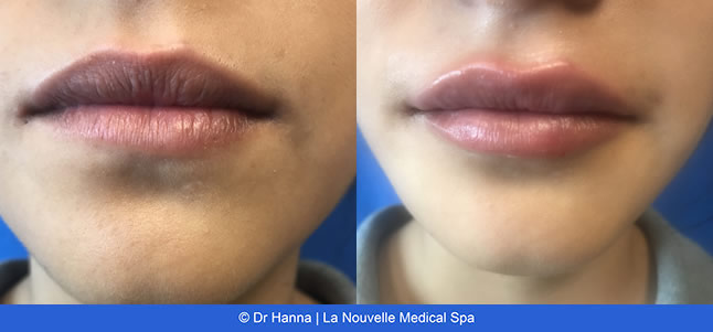 lip enhancement before and after with juvederm and volbella, oxnard